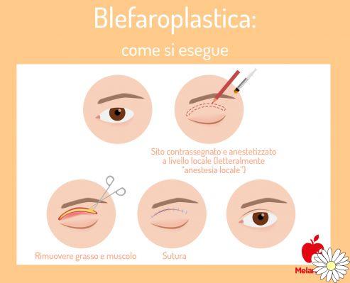 Blepharoplasty: what it is, what it is for, how it is done, how much it costs